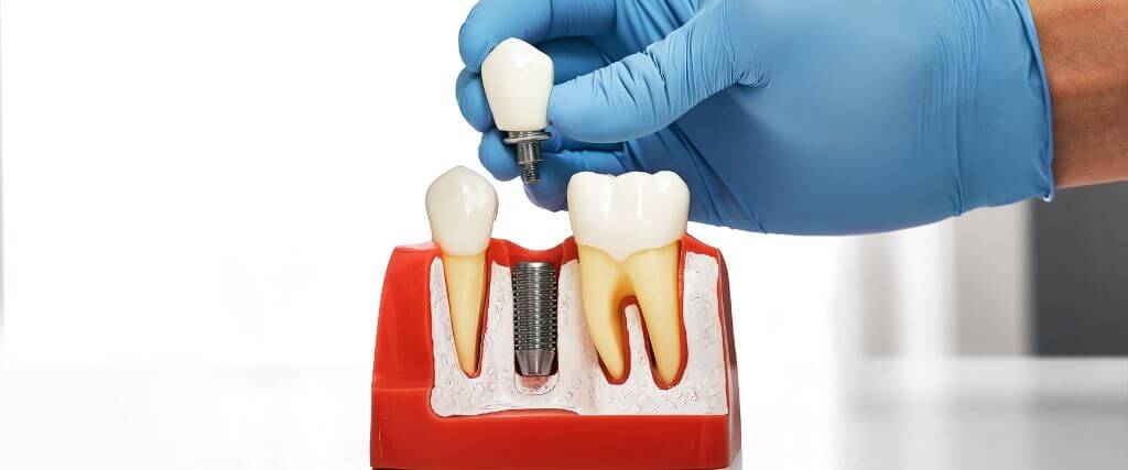 Dental Implants 101: How Your Jawbone Supports a New Tooth