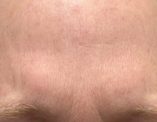 Botox 1 after