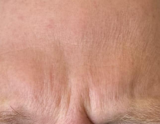 Botox 1 before
