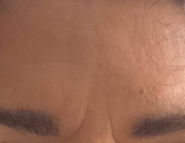 Botox 2 after