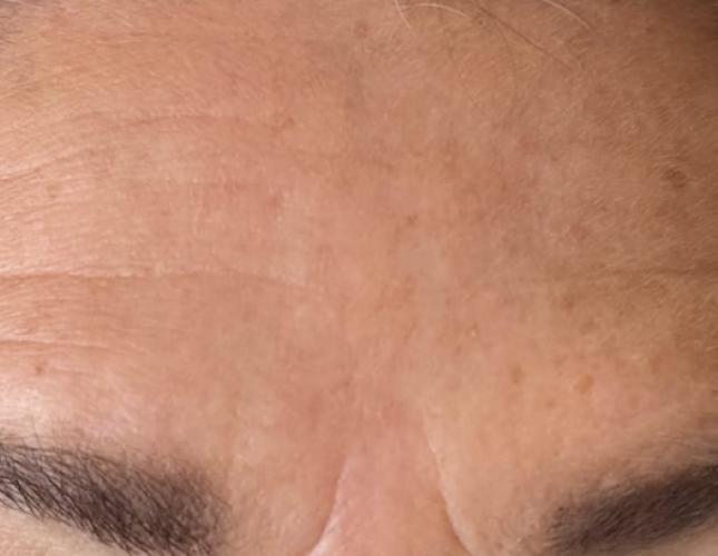 Botox 2 before