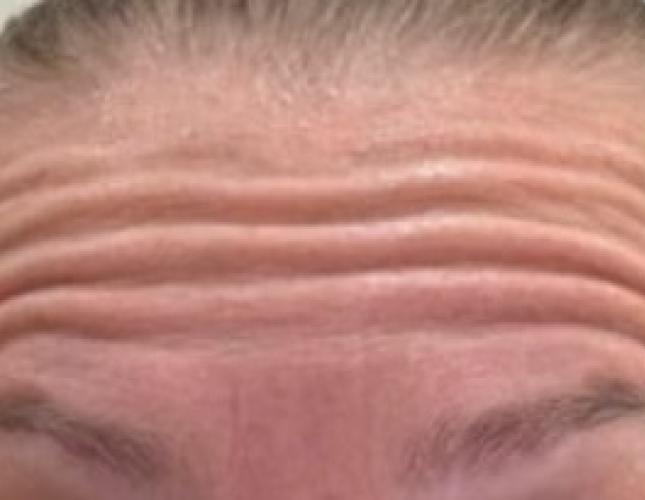 Botox 3 before