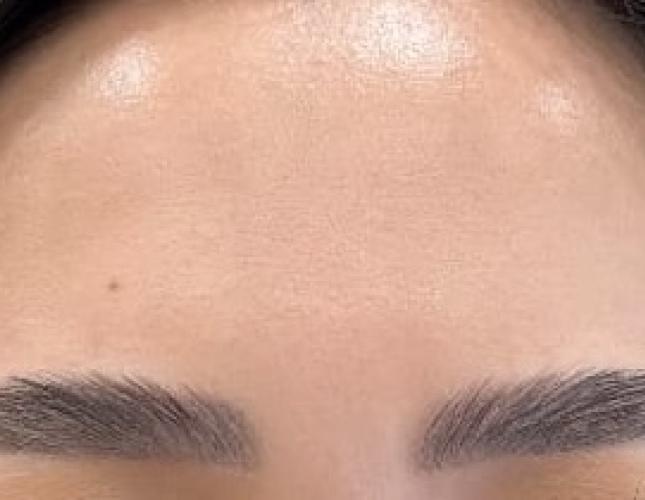 Botox 4 after