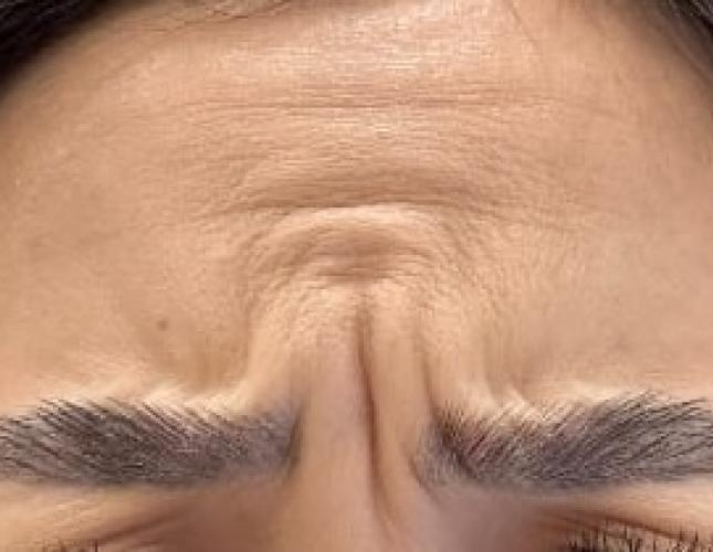 Botox 4 before