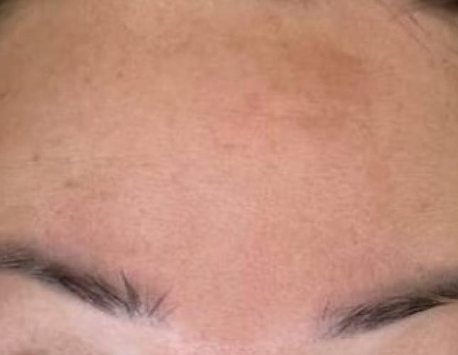 Botox 5 after