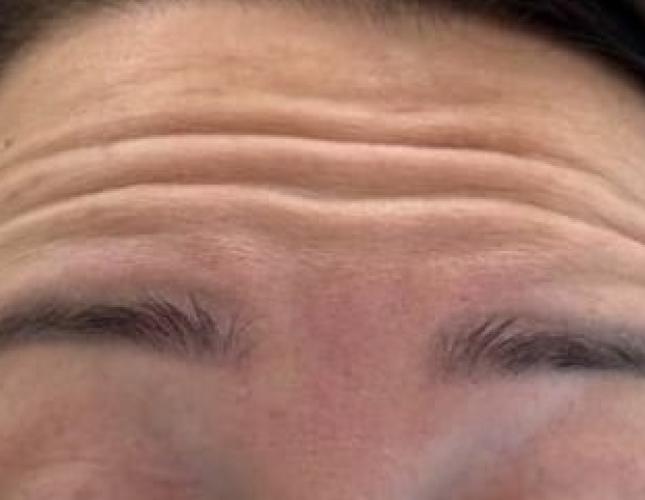 Botox 5 before