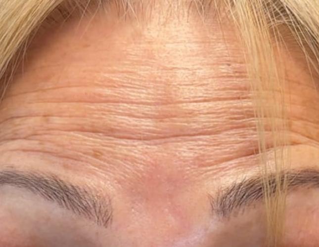 Botox 6 before