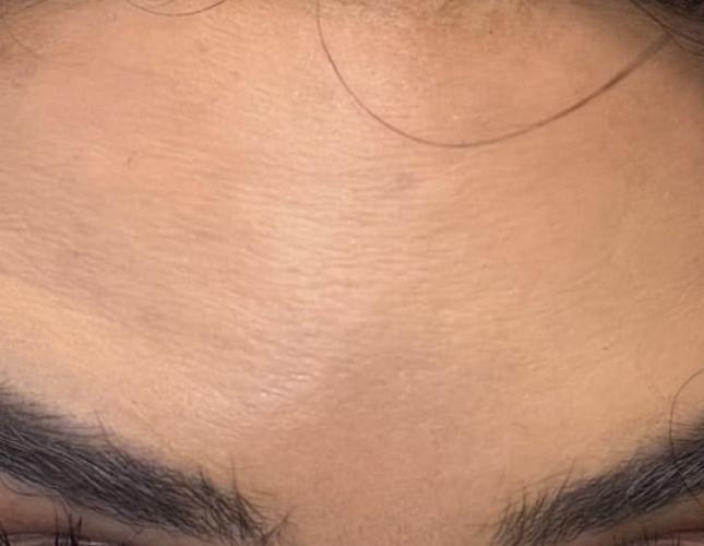 Botox 7 after