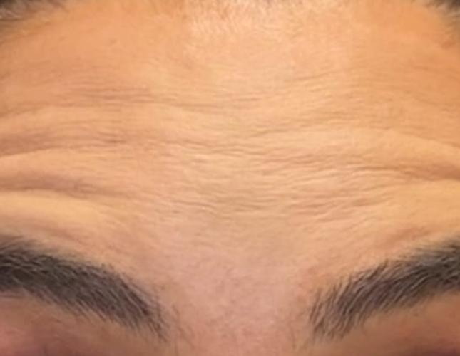 Botox 7 before