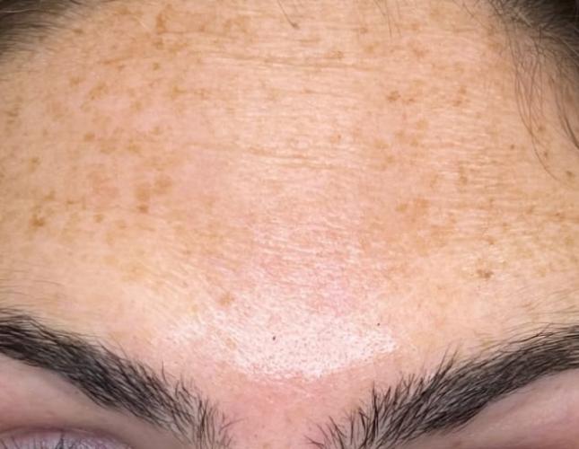 Botox 8 after