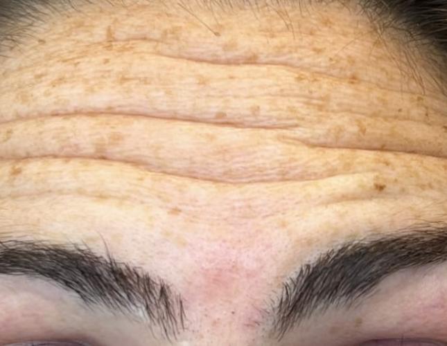 Botox 8 before