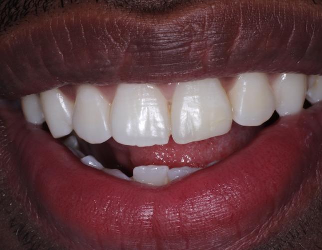 Composite Restoration after