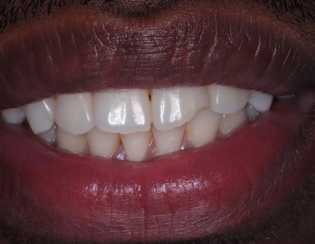 Composite Restoration before