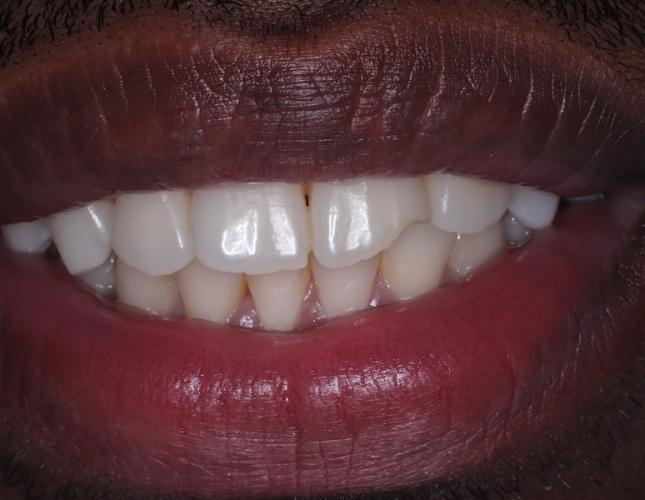 Composite Restoration before