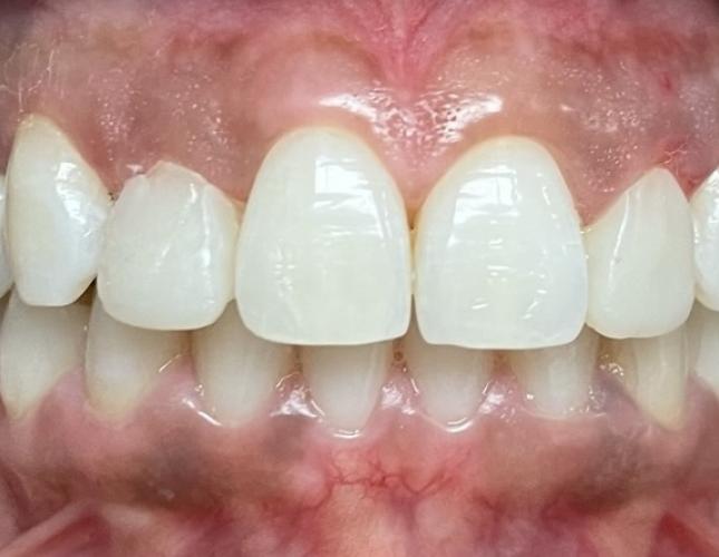 Single Crown after