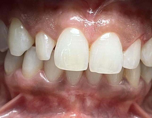 Single Crown before