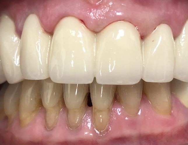 Top Arch Dentures after