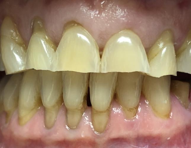 Top Arch Dentures before