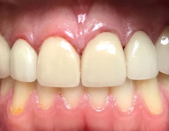 Veneers 1 after