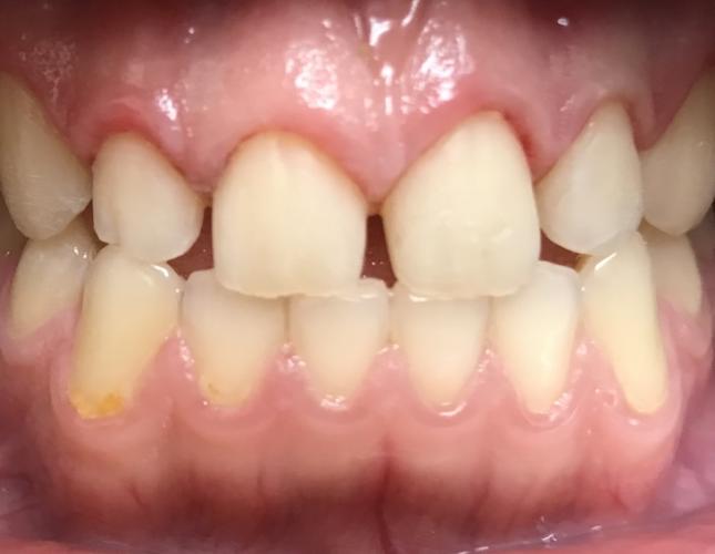 Veneers 1 before