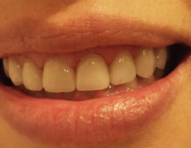 Veneers 2 after