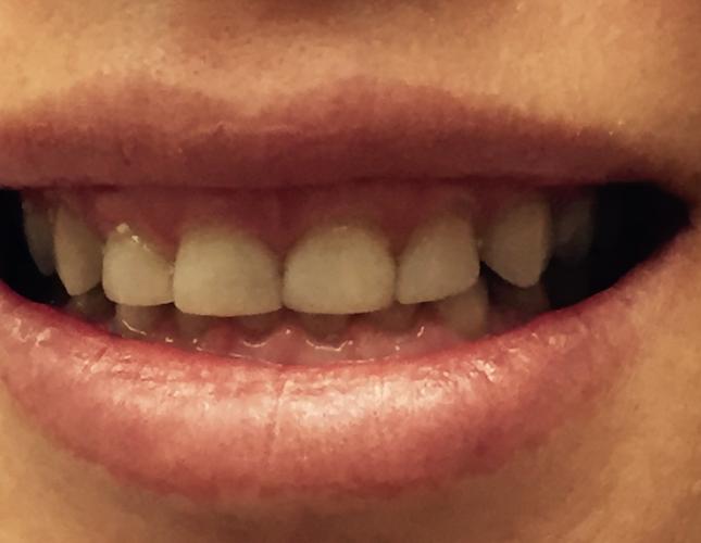 Veneers 2 before