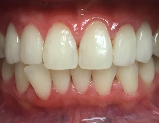 Veneers 3 after