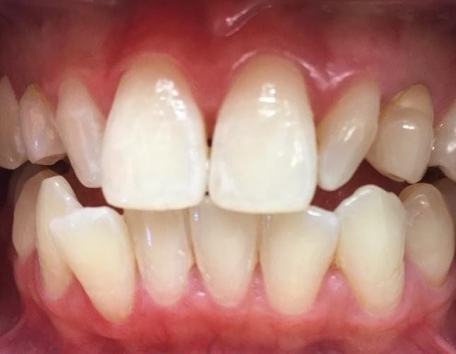 Veneers 3 before