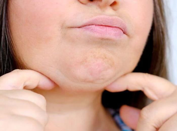 Chin Up! A Complete Guide to Chin Ptosis