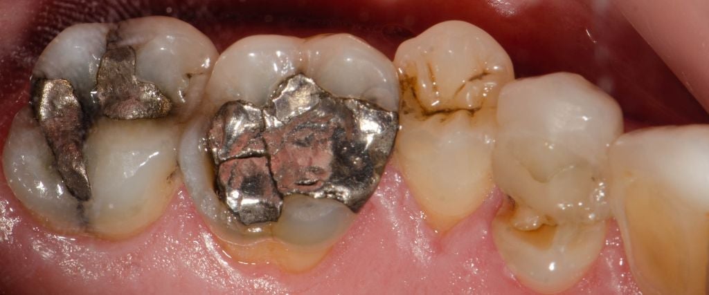 5 Reasons Most Dentists Have Stopped Using Mercury in Dental Procedures